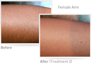 Female Arm IPL Results
