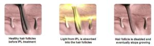 How IPL Hair Removal Works