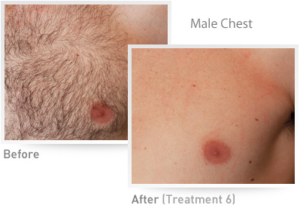 Male Chest IPL Results