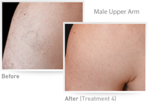 Male Upper Arm IPL Results