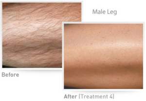Male leg IPL Results